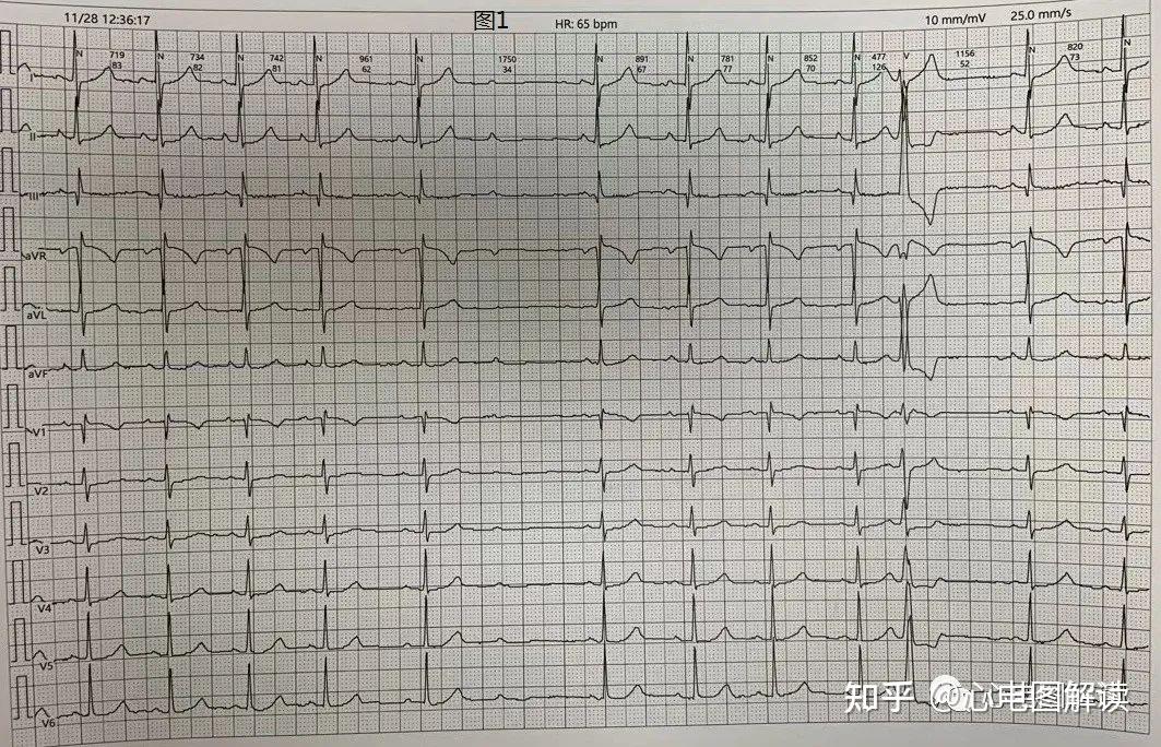 二度房室传导阻滞,室性早搏