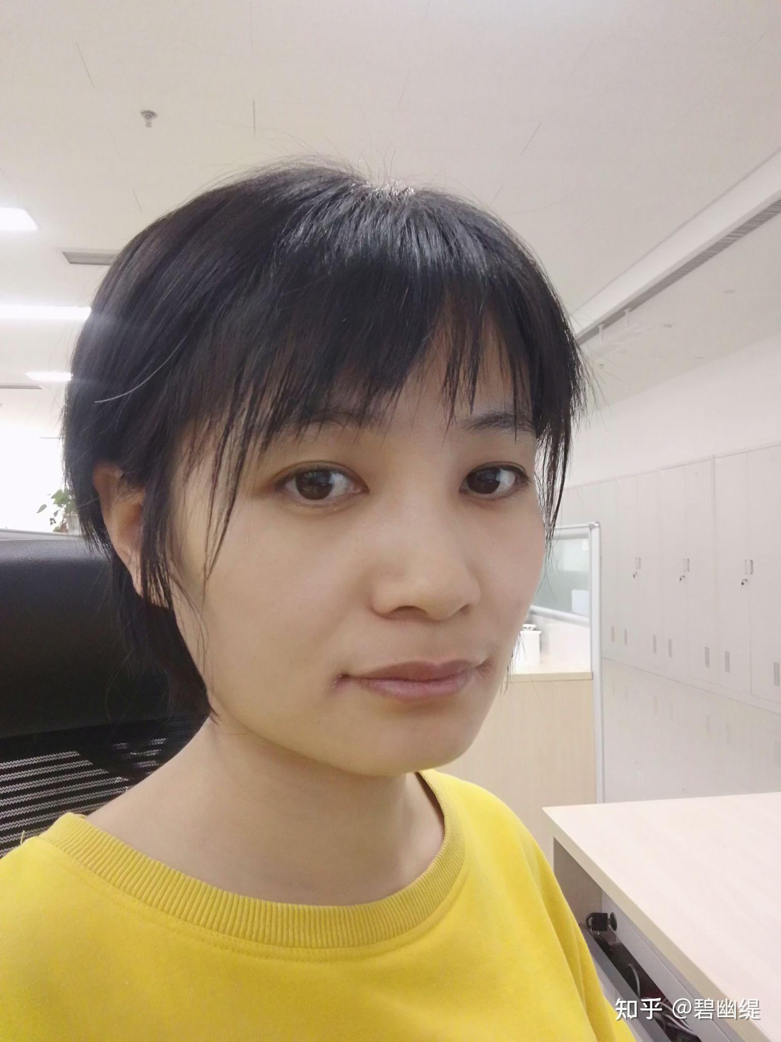 开帖记录30岁大龄女青年正畸过程龅牙前突深覆合和深覆盖严重