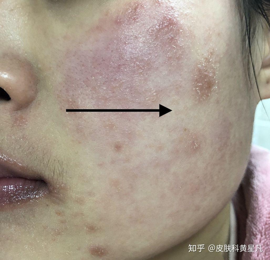 提示这类人群更容易因为接触或者暴露金属镍而出现过敏性接触性皮炎