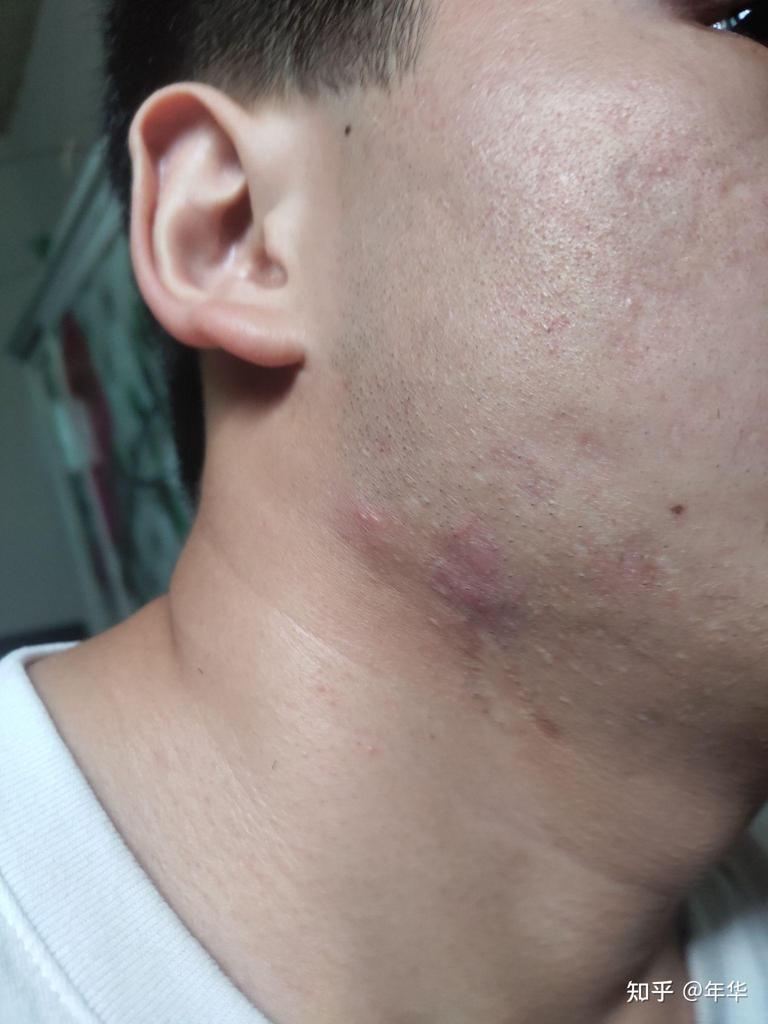 (痤疮引起的)我的增生性瘢痕恢复之路