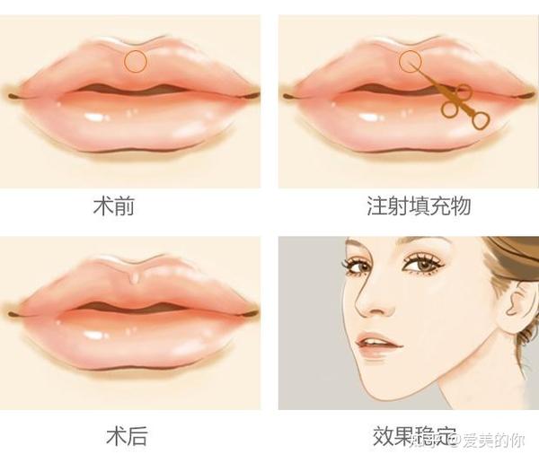 唇珠整形有哪些手术方式? - 知乎