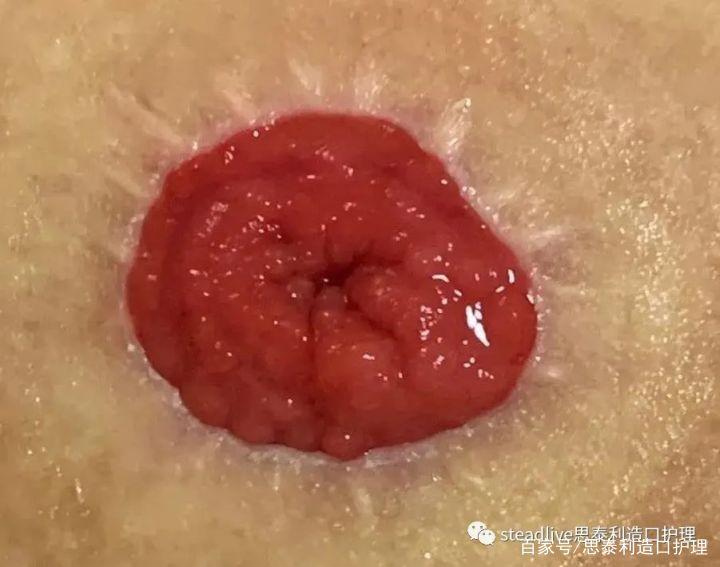 泌尿造口周围皮肤并发症-尿酸结晶!