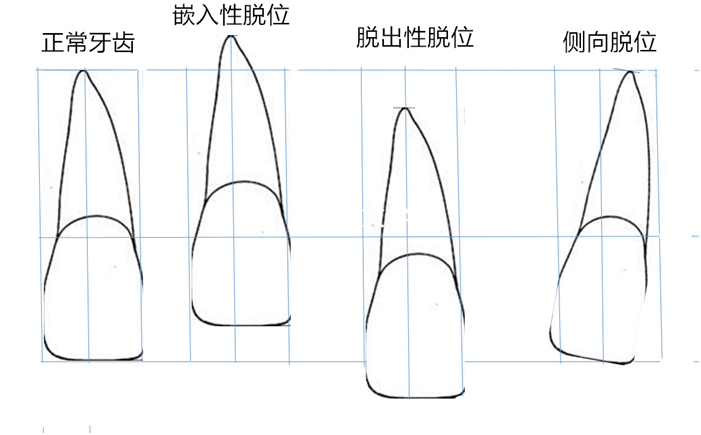 脱出性脱位的牙齿,若是部分脱出,可发现患牙比正常相邻牙齿明显长一截