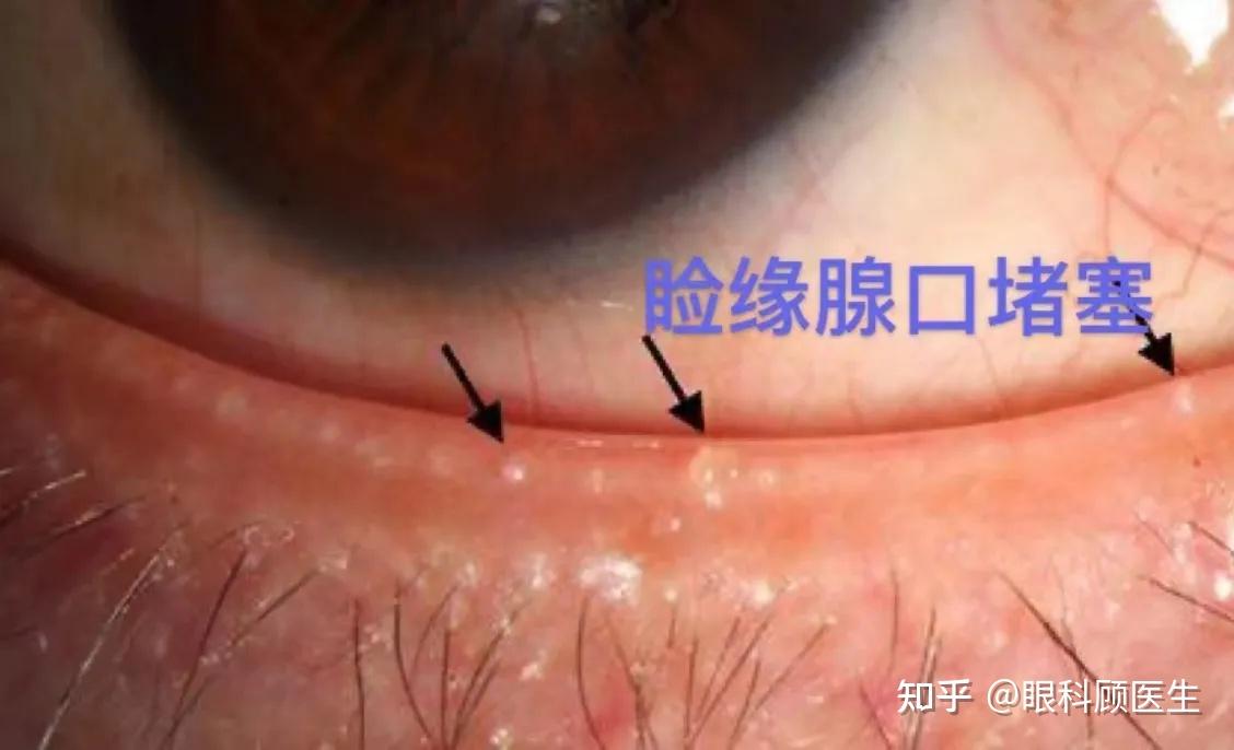 什么是睑板腺功能障碍?会有什么危害?