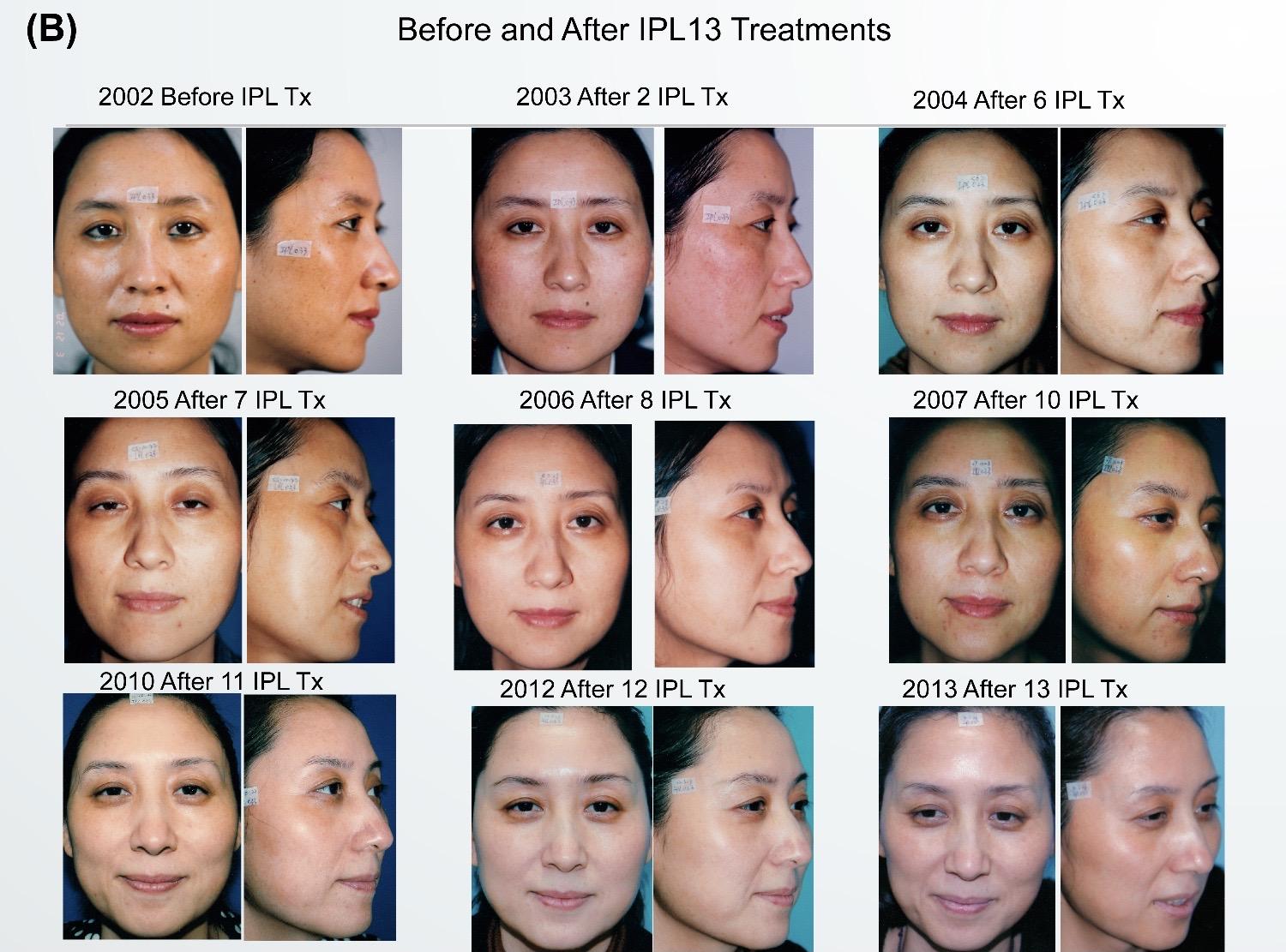 光子嫩肤最全科普,别再IPL OPT AOPT BBL ICON傻傻分不清楚了! - 知乎