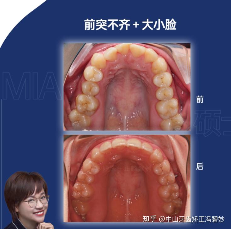 而且因为有一个龋齿长期不用,形成了偏侧咀嚼的不良习惯.