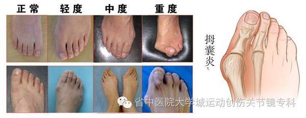 如何自我纠正拇指外翻 知乎