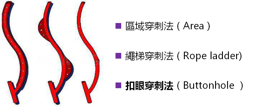 自体动静脉内瘘扣眼穿刺点的超声表现