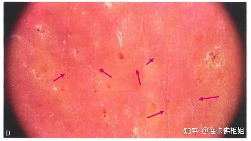 秋冬皮肤干燥,爆炸起皮,还红敏刺痛该怎么办? - 知乎