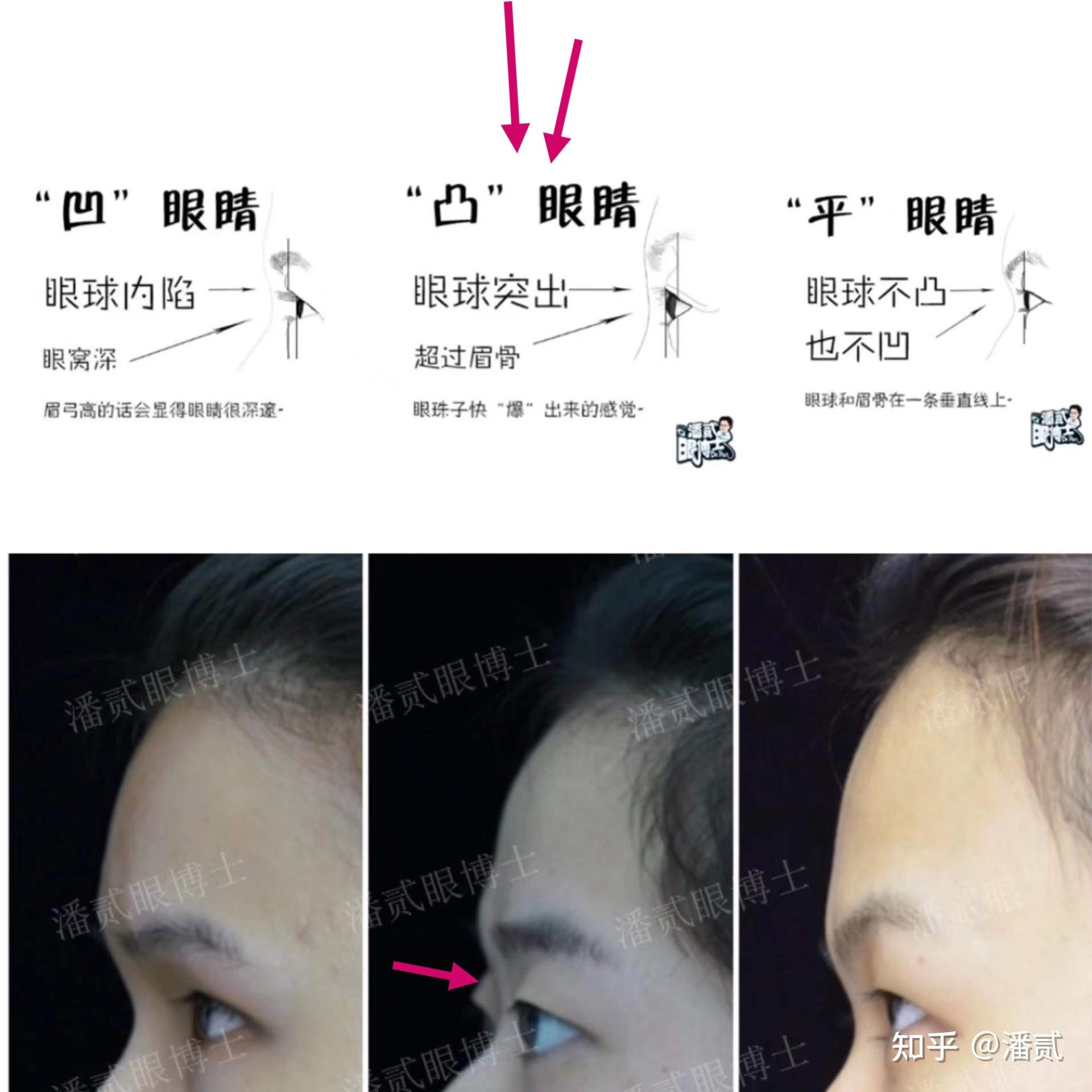 凸眼睛者：眼球突出高于眉骨、上睑凹陷和（或）多层，双眼皮设计为何不宜过宽？ - 知乎