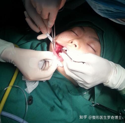 局部麻醉下磨骨瘦脸下颌角削骨手术过程