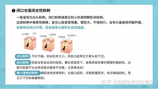 为什么越去角质,闭口越多? - 知乎