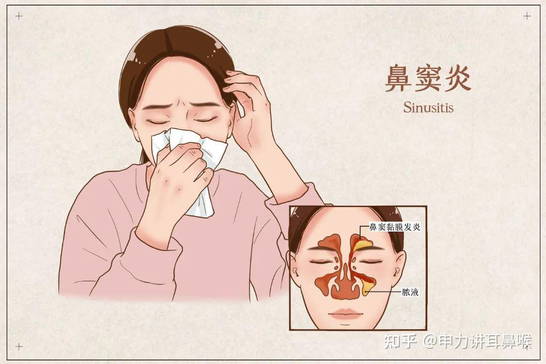 你以为鼻窦炎只是小毛病看完你就明白了