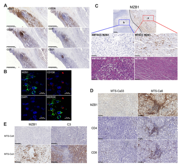 Mtcc Human The Journal of Pathology | 中山大学第一附属医院王芬/罗镇华/王连唐合作报道MTSCC肾癌分子分型成果 - 知乎