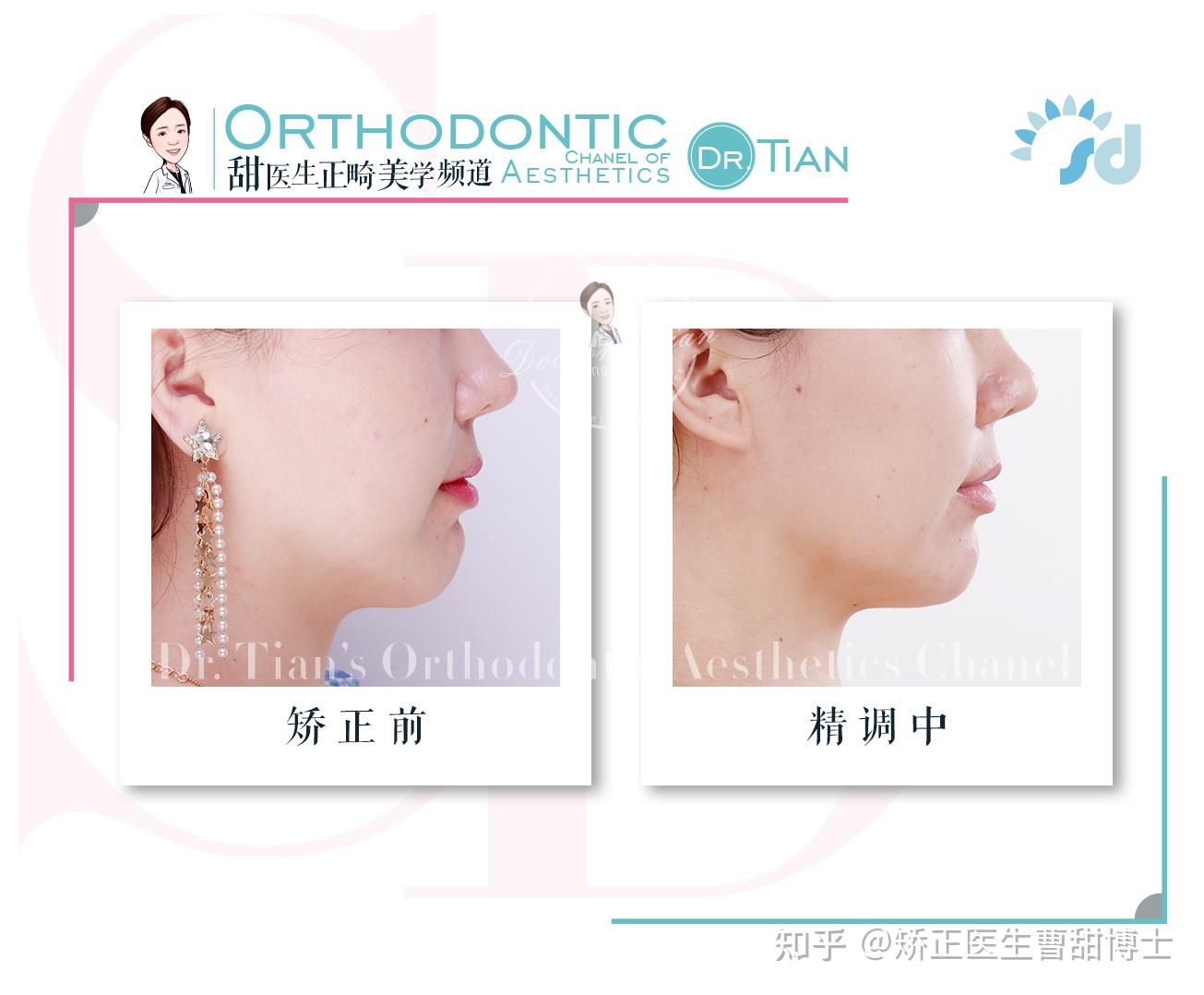 正畸中说的“颏肌紧张”是什么?牙齿矫正能改善颏肌紧张吗? - 知乎