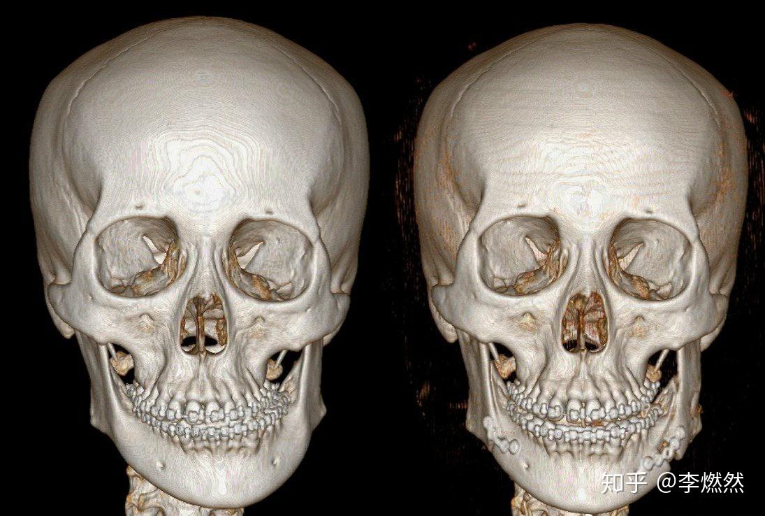 不管做不做表情都能明显看出面部的歪斜,放在行话里,就是偏颌.