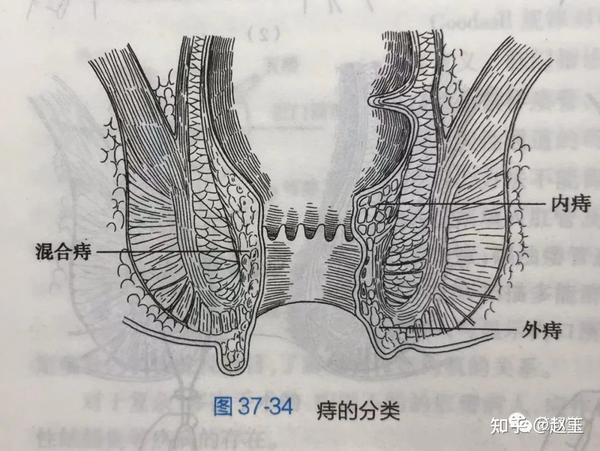 痔疮 - 知乎