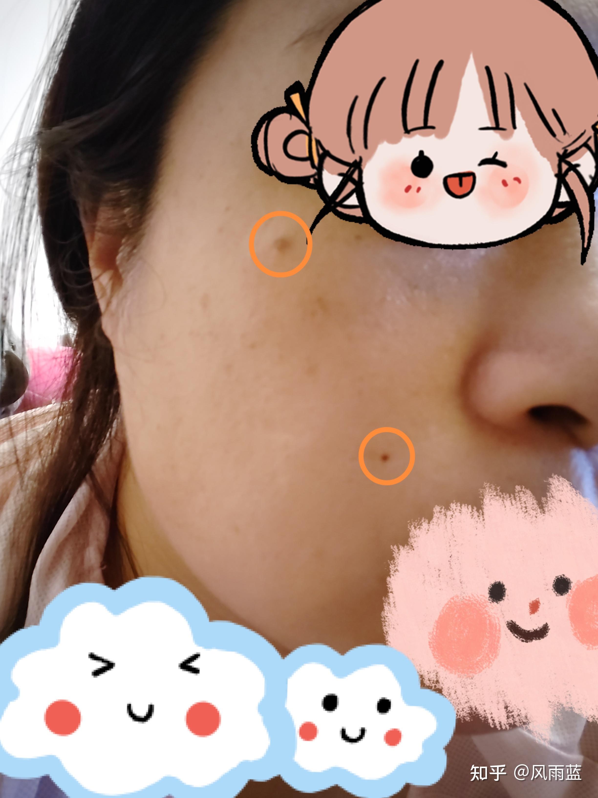 上海九院点痣及后续恢复记录