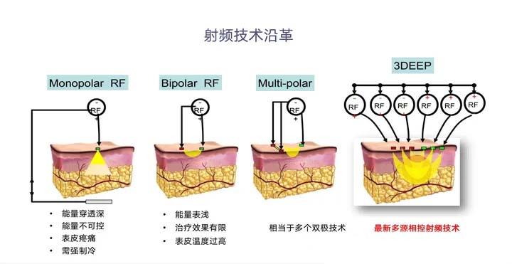 微针/黄金微针/相控微针?到底适合做哪个? - 知乎