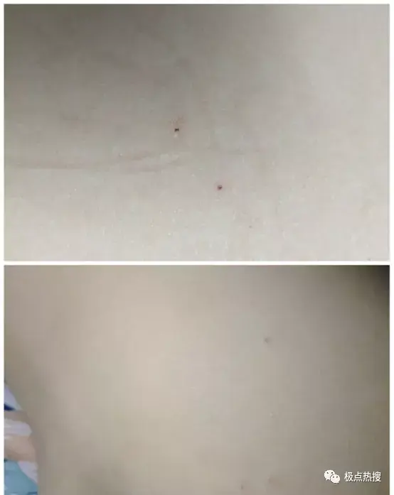 幼儿园多名孩子身上出现针眼这是容嬷嬷转世