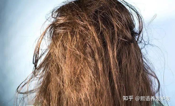 通常,正常人每天可脱落70~100根头发,如果每天脱发超过100根,那就属于