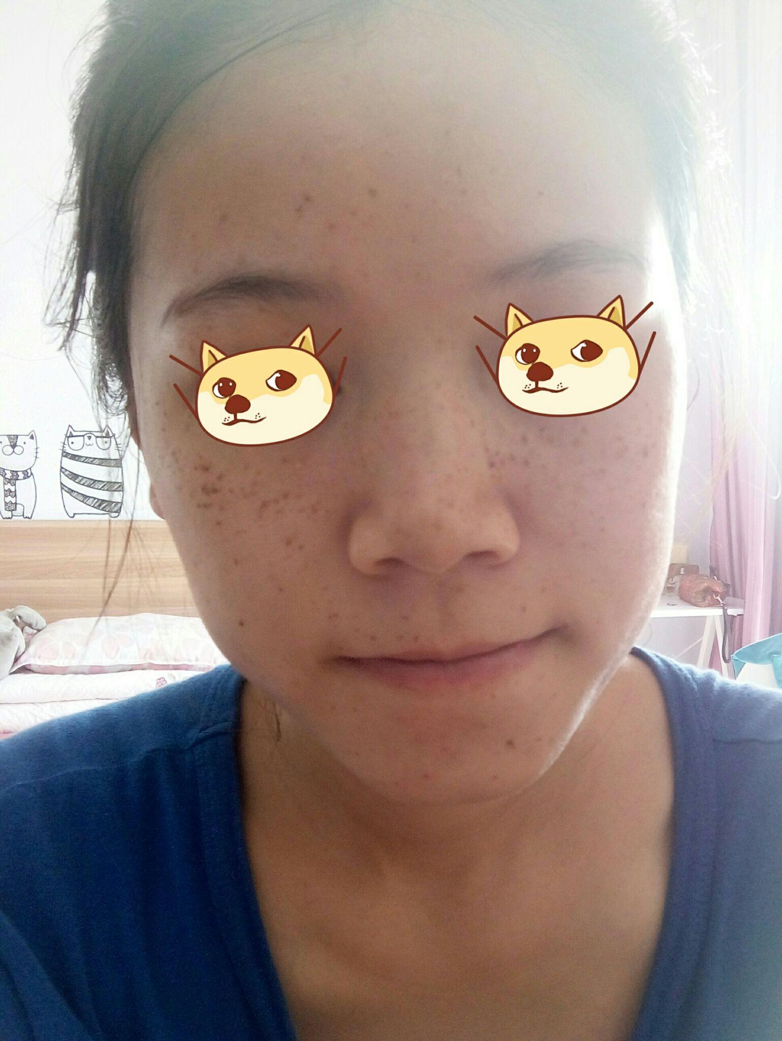 怎么去雀斑,激光祛斑怎么样?