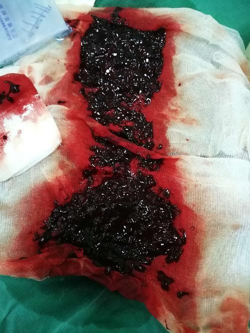 癌症和血栓:为什么会发生以及如何预防