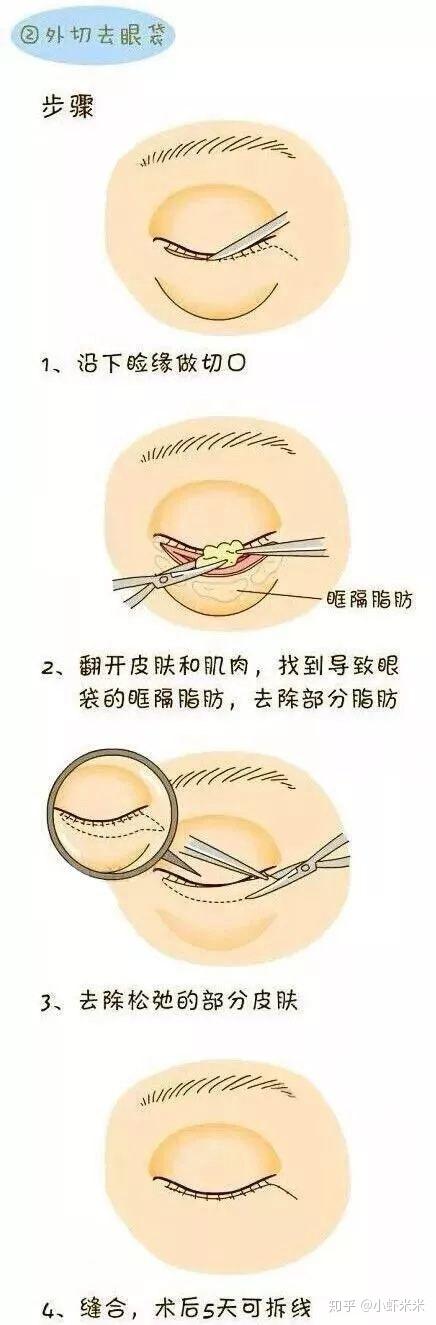 水剥离祛眼袋知识科普