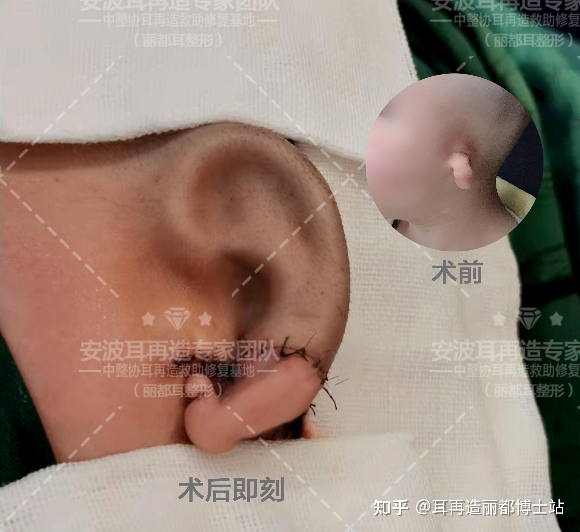婴儿耳朵软骨没长开图图片