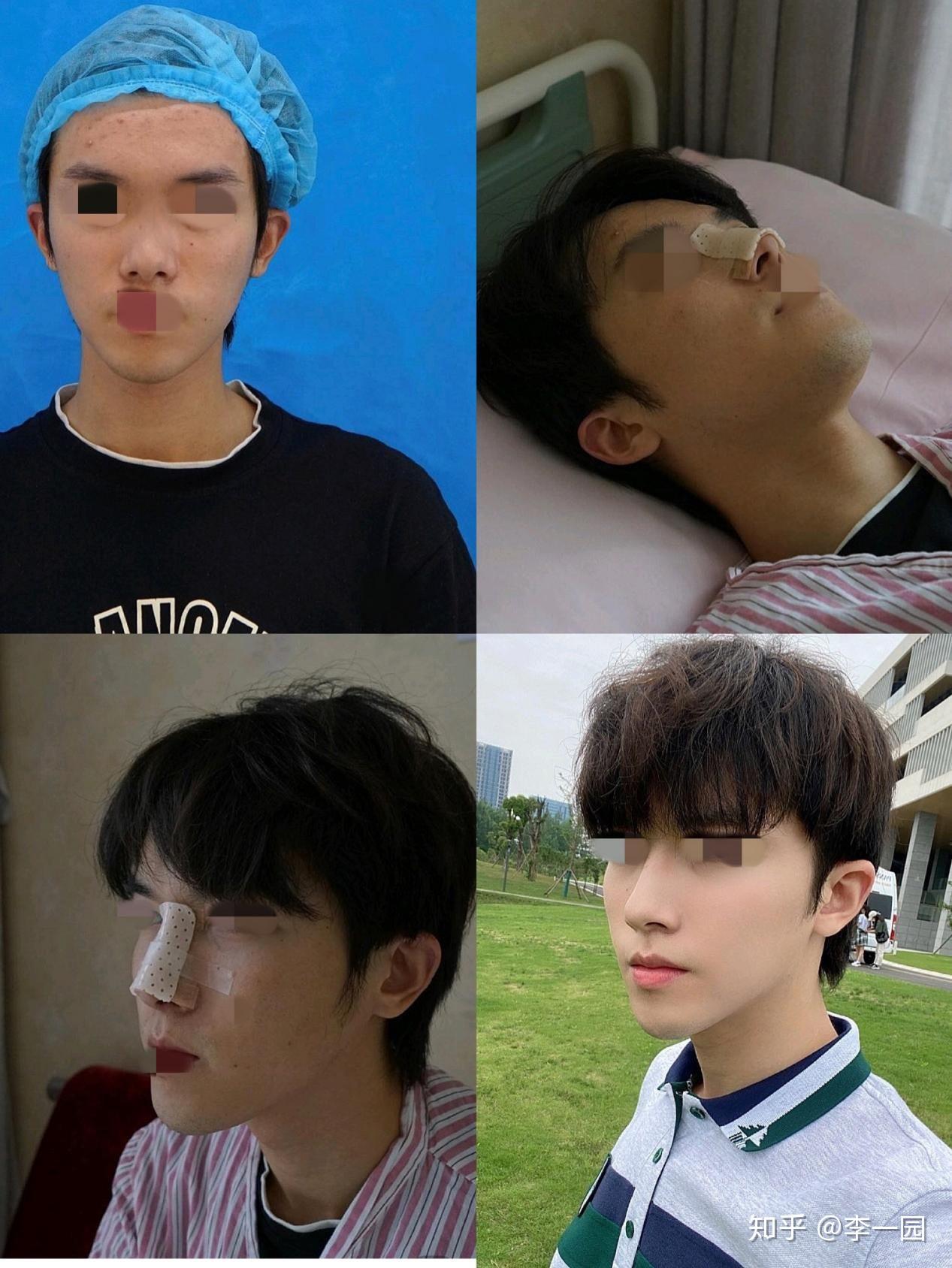 但是真的很帅)脸型也是那种标准的帅哥脸,但是基本上没有鼻梁,鼻基底