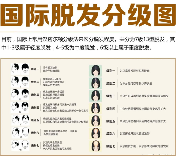 前额脱发、头顶稀疏,不同等级的脱发怎么有效治疗?脱发植发真的有用么?能维持多久? - 知乎