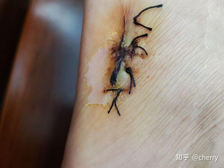 11(第13天)  伤口痒 社区医院拆线吃d3补钙冲剂 消毒换纱布 (3天后再