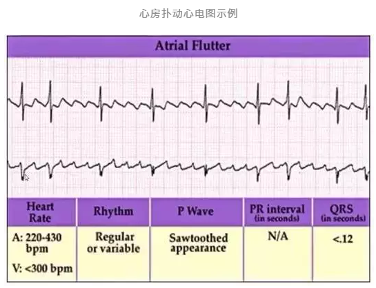 房扑患者心电图的锯齿波在下壁导联(Ⅱ,Ⅲ和avf)最为明显,有时v1导联