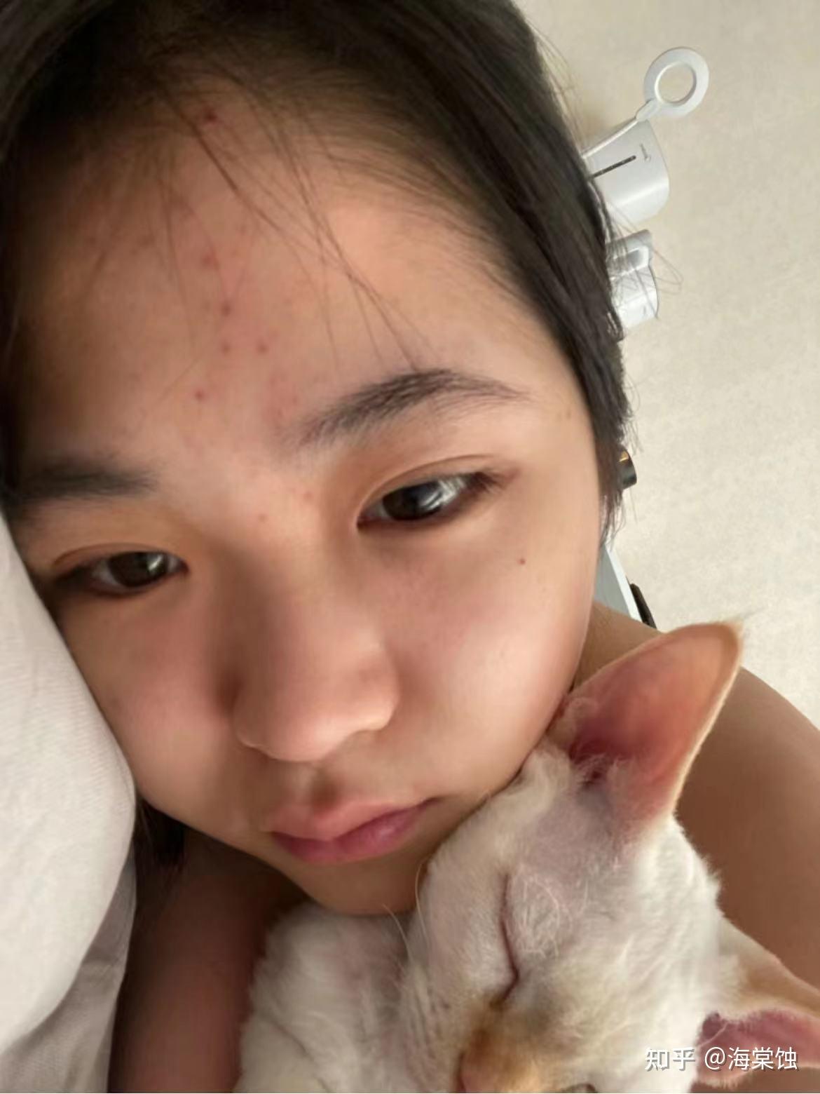 22岁,脸部状态差,浮肿虚胖,没钱做医美怎么办?