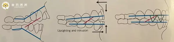 教授经验 近中倾斜磨牙的直立获得间隙内收前牙的临床经验 知乎