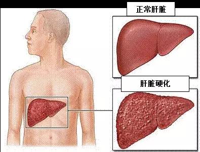 李中伟肝腹水用什么药物治疗