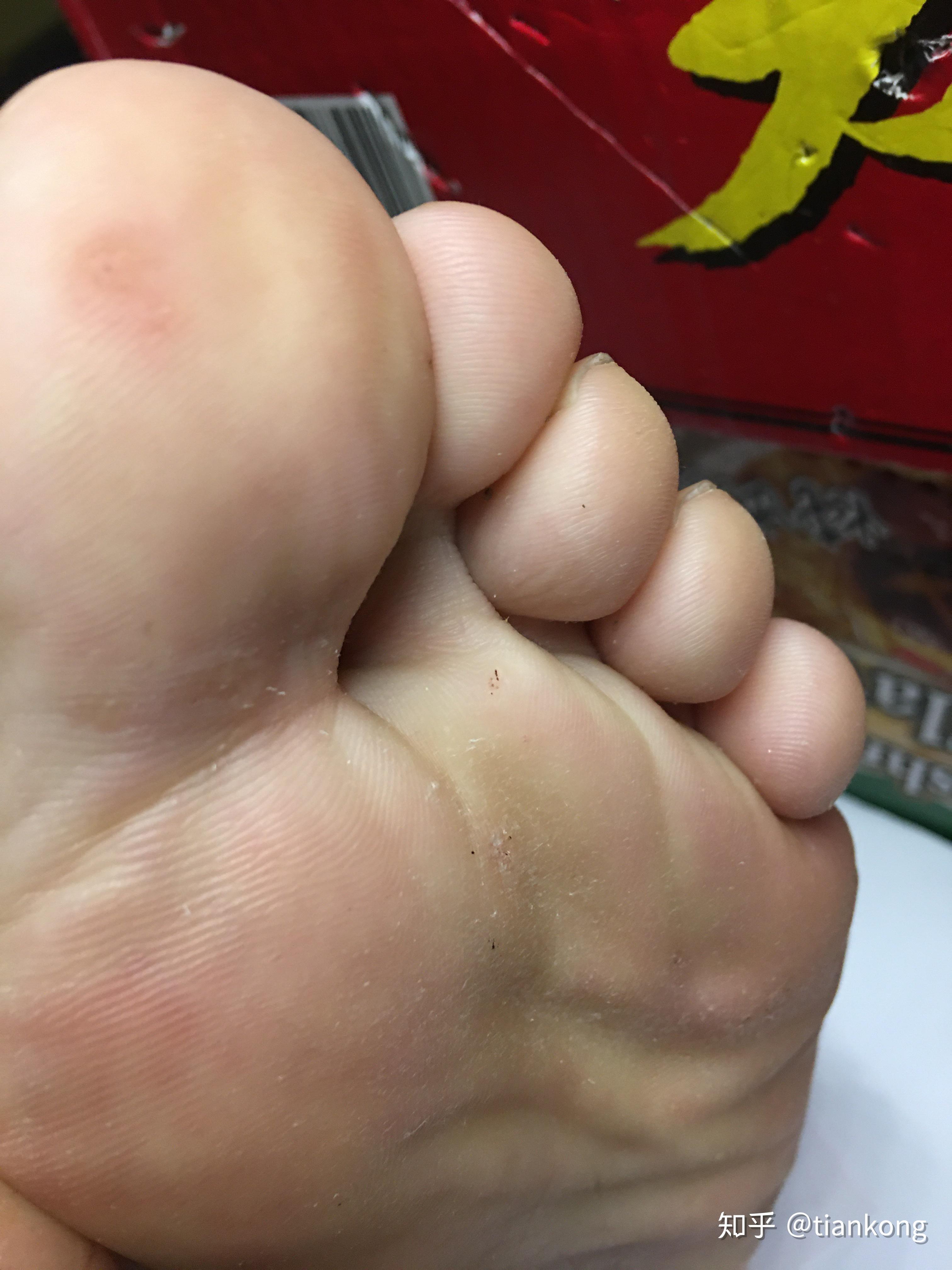 受跖疣困扰2年,最近发现有自愈迹象 - 知乎