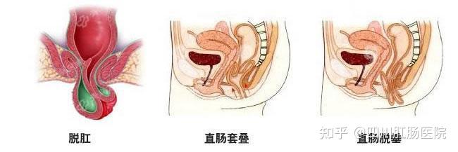 脱肛有什么特征不能不知道 - 知乎