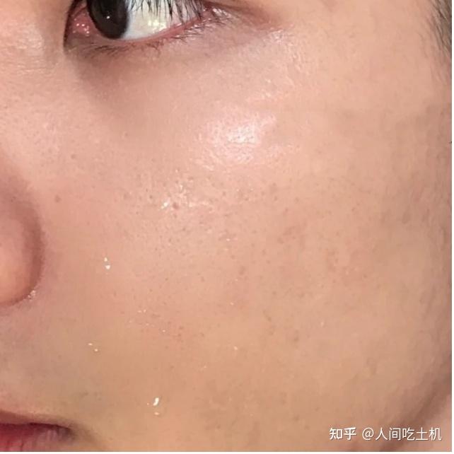 男生毛孔粗大出油长痘怎么护肤用哪些护肤品有效