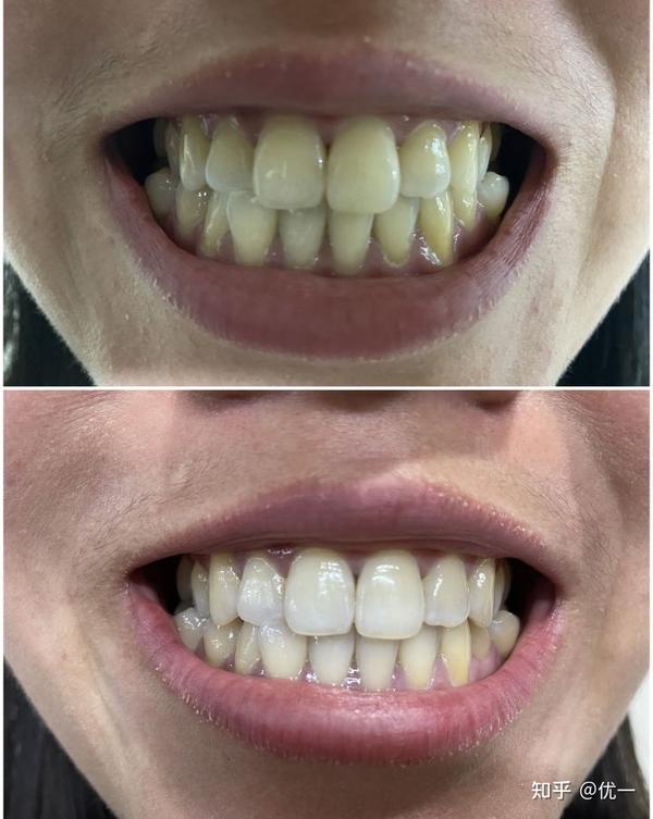 我的牙齿好黄,而且还能抠下来黄黄的东西,有啥简单高效去牙黄的产品吗