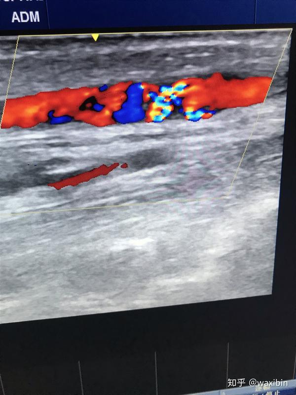 从最新的血管通路指南看一例自体动静脉内瘘狭窄的处理