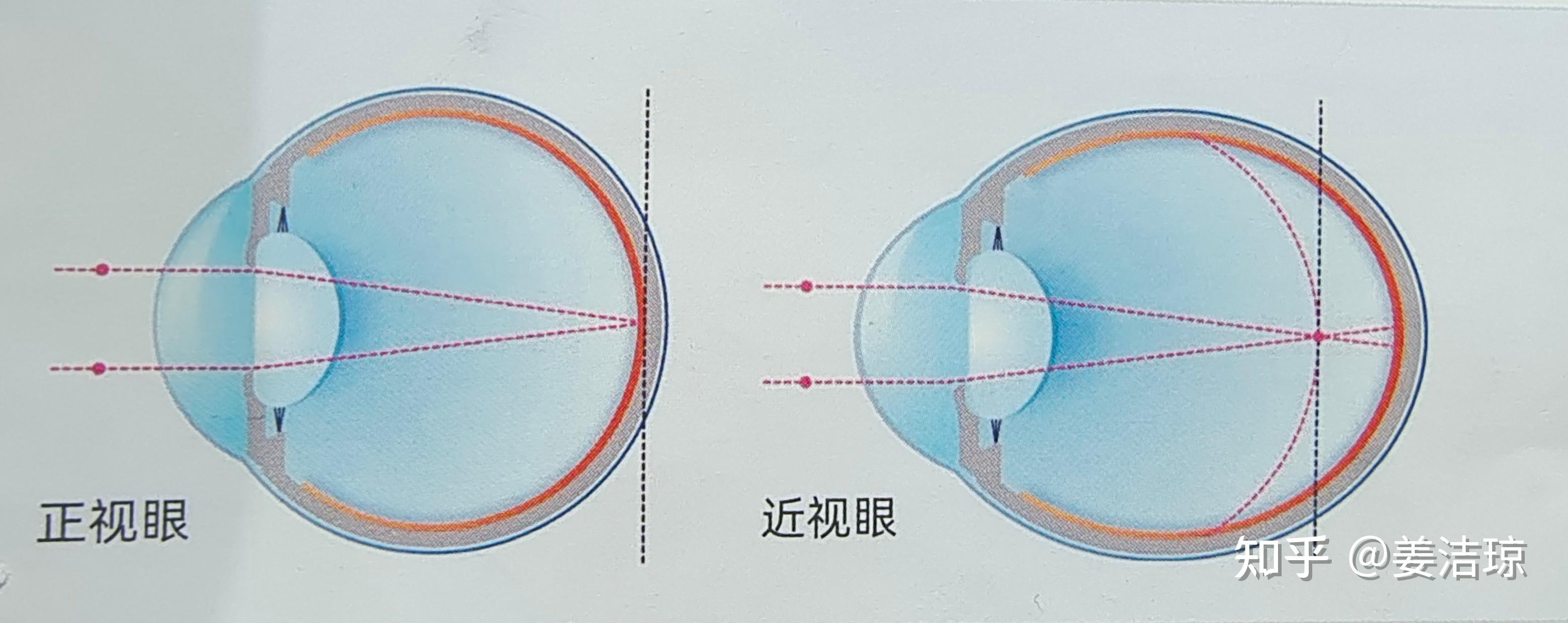 6-18岁:采取有效近视防控措施,控制眼轴过快增长;18岁以上:防止眼睛
