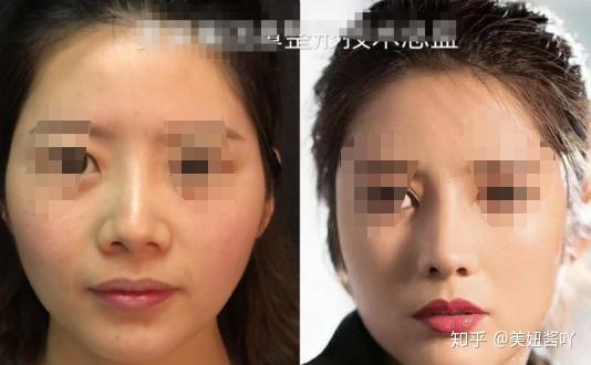 北京热门隆鼻医生测评 哪些擅长自然风 哪些擅长网红风 知乎