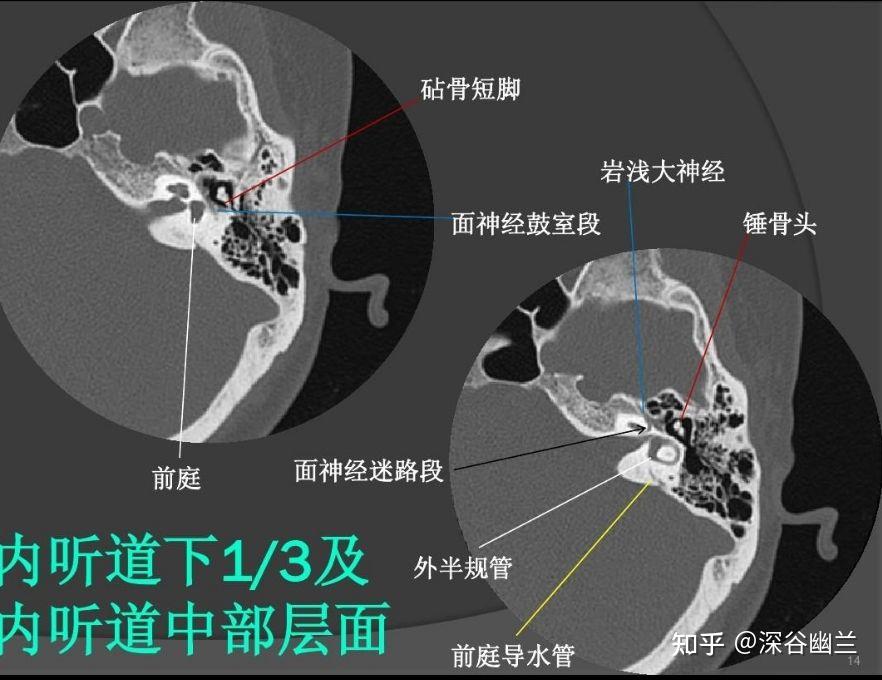 神經出腦橋後,與聽神經在內耳道一起行走,出內耳道後進入面神經管,再