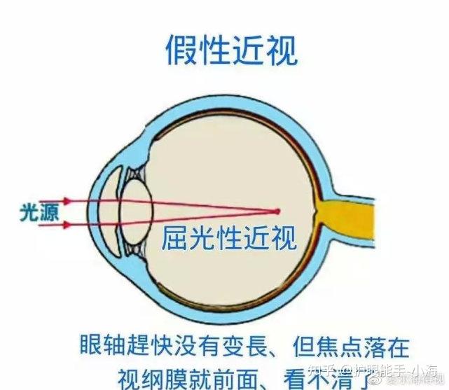 恢復其對晶狀體的調節功能,就可以使眼球恢復原有的狀態,阻斷近視的