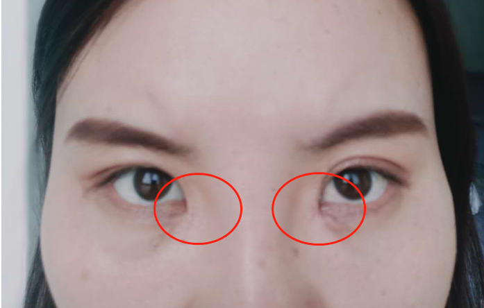 ber仿生内眦赘皮修复内眼角修复并不是你想要什么形态都是可以的