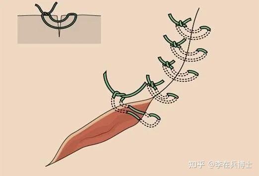 缝针后怎样才能不留疤?最全方法整理 - 知乎