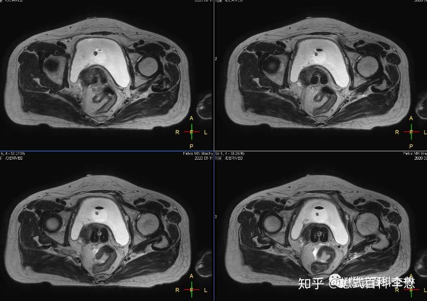 图8:t2wi显示施源器位置图9,10:mdixon脂肪抑制图像必要时候可以行