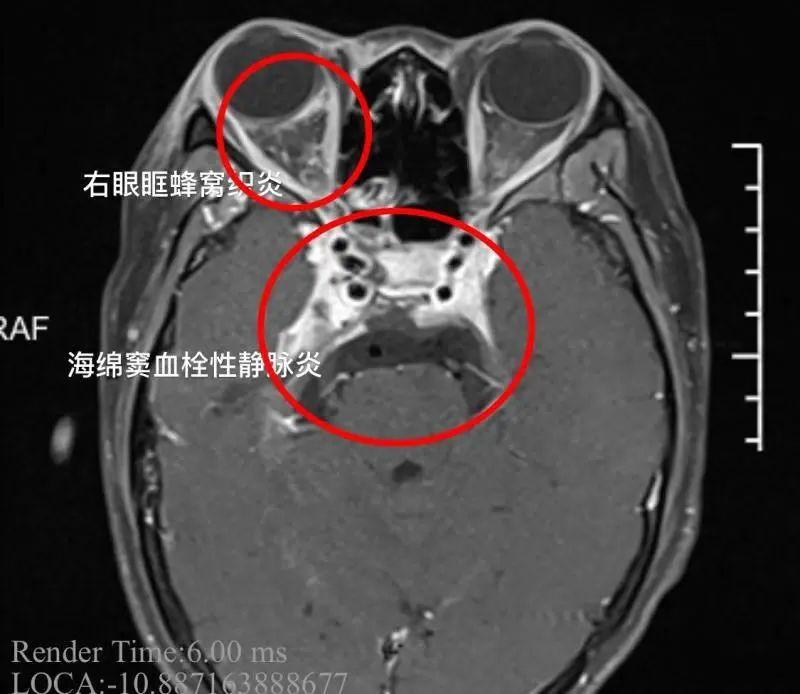 “危险三角区”的痘痘不能挤?这样的挤痘方式,可能给皮肤带来一系列灾难! - 知乎