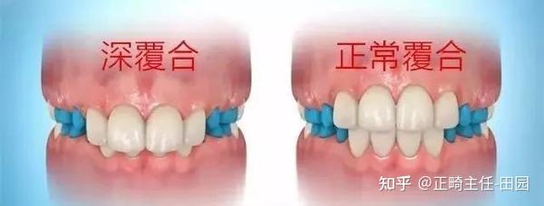 牙齿深覆合有必要去做正畸吗？ 知乎